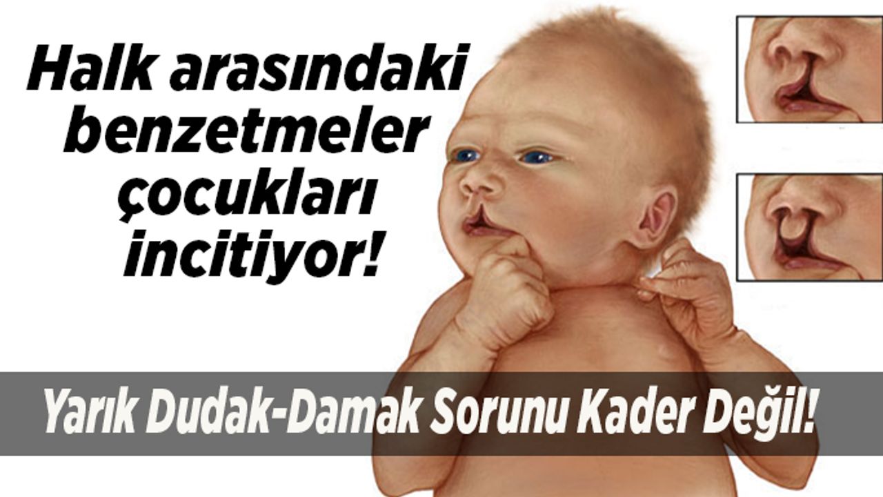 Yarık Dudak-Damak Sorunu Kader Değil!