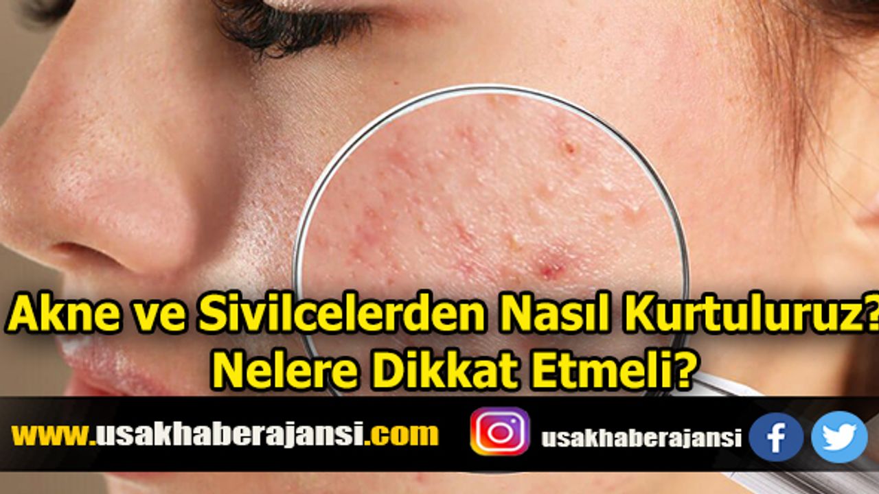 Akne ve Sivilcelerden Nasıl Kurtuluruz? Nelere Dikkat Etmeli?