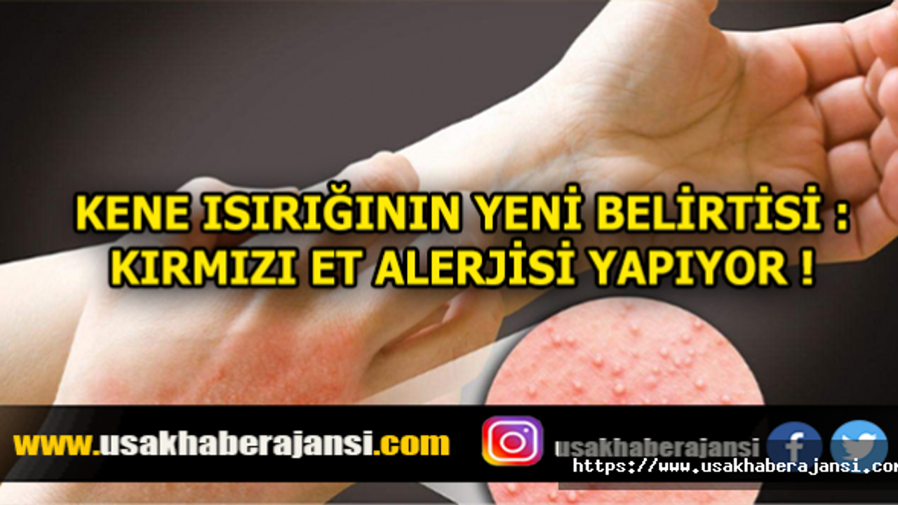 Kene Isırığının Yeni Belirtisi :  Kırmızı Et Alerjisi Yapıyor!