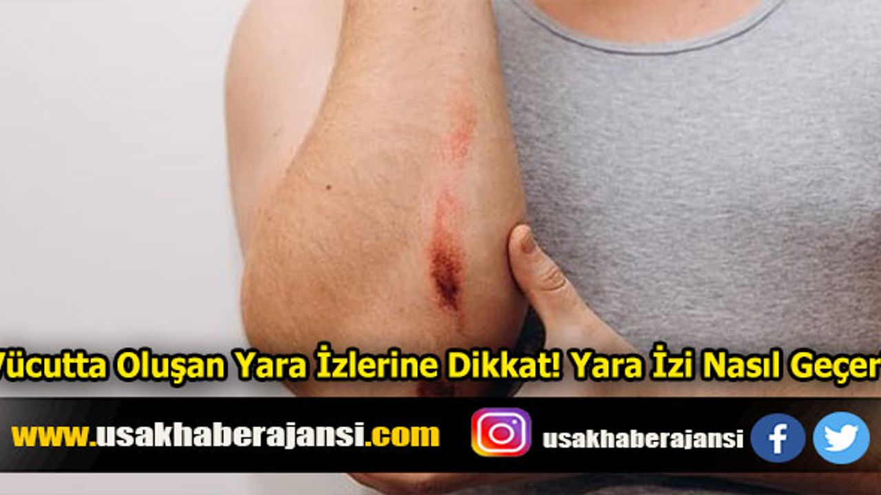 Vücutta Oluşan Yara İzlerine Dikkat! Yara İzi Nasıl Geçer?