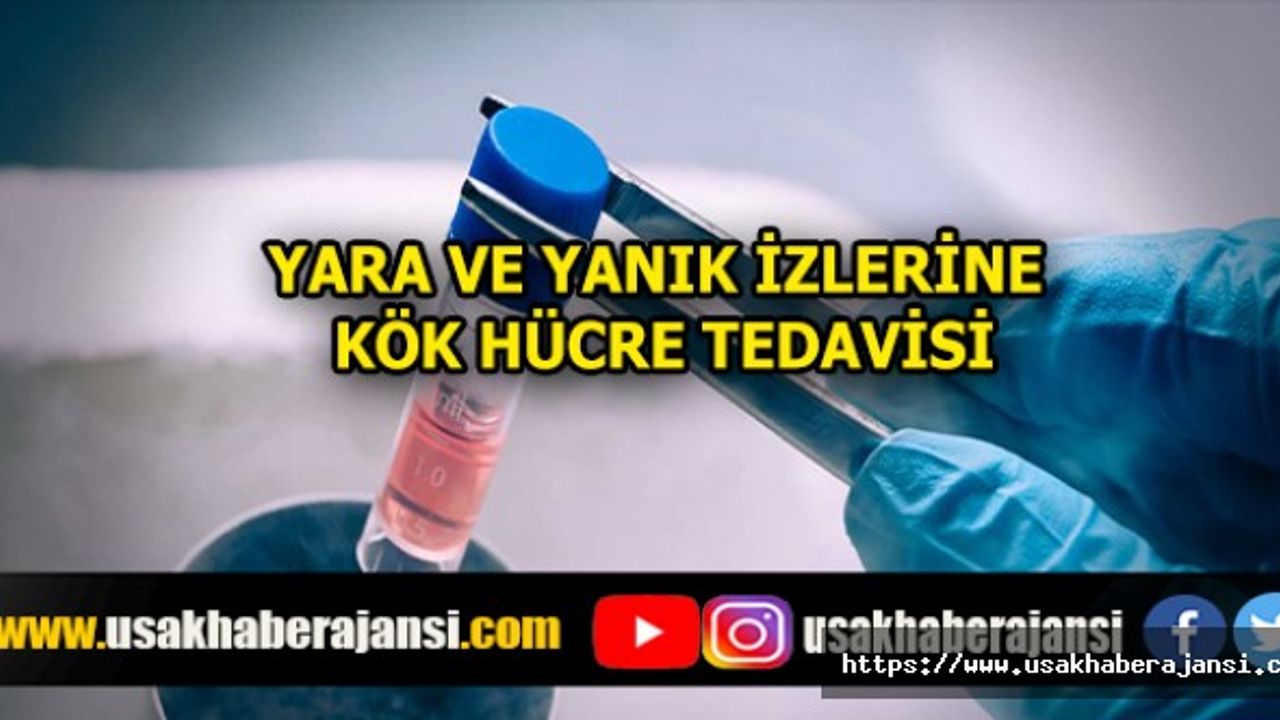Yara ve Yanık İzlerine Kök Hücre Tedavisi