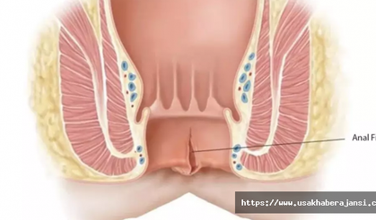 Anal Fissur