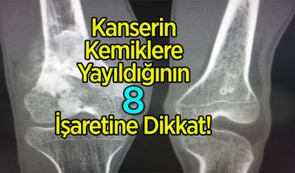 Kanserin Kemiklere Yayıldığının 8 İşaretine Dikkat!