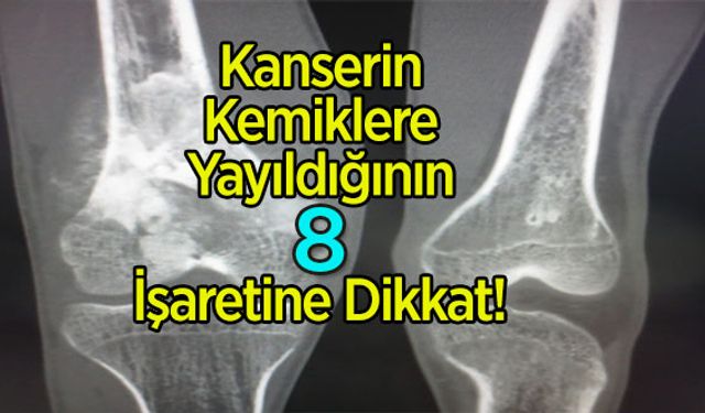 Kanserin Kemiklere Yayıldığının 8 İşaretine Dikkat!